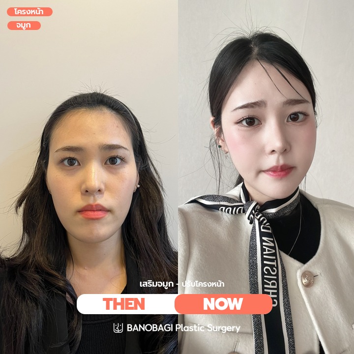 เคส Before & After จาก Banobagi