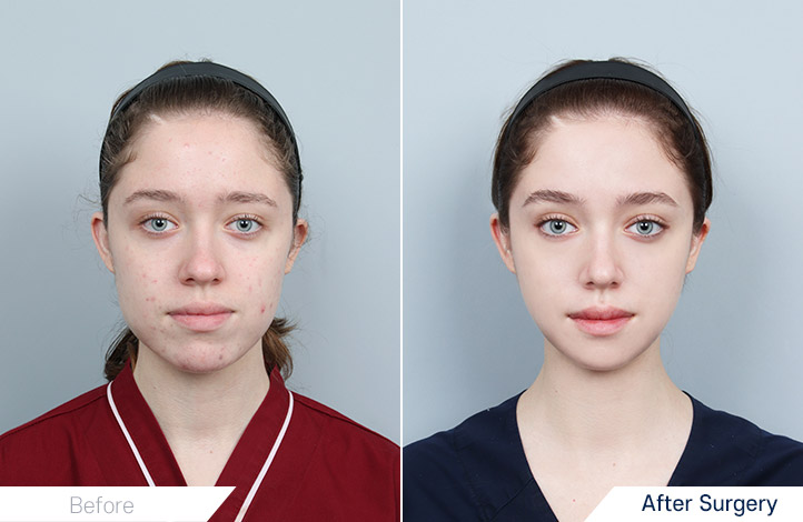 เคส Before & After ผ่าตัดกรามและเสริมคางจาก DA Plastic Surgery
