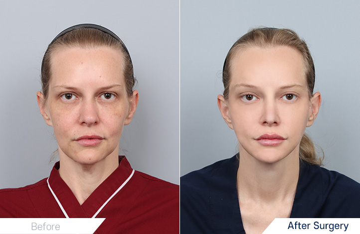 เคส Before & After ยกหน้า ดูดไขมัน และเสริมหน้าอกจาก DA Plastic Surgery