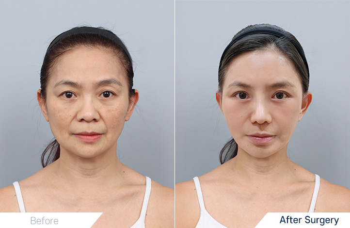 เคส Before & After จมูก ยกหน้า ยกคอ และศัลยกรรมตาจาก DA Plastic Surgery
