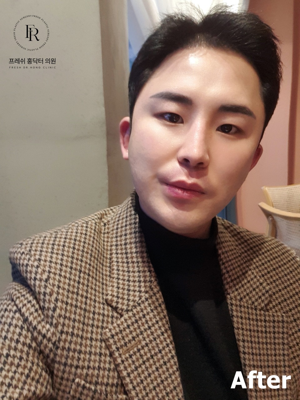 รีวิวหลังดูดไขมันใบหน้าและเหนียงผู้ชายจาก Fresh Dr. Hong Clinic