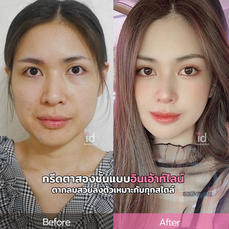 เคส Before & After จาก ID Hospital