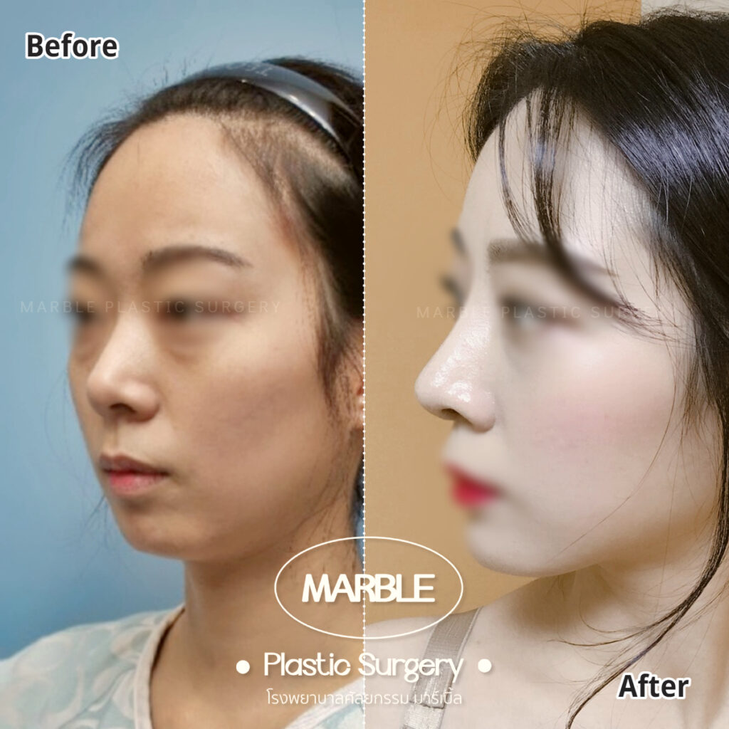 เคส Before & After จาก Marble