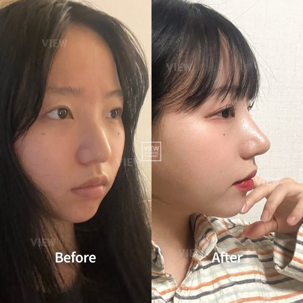 เคส Before & After จาก View