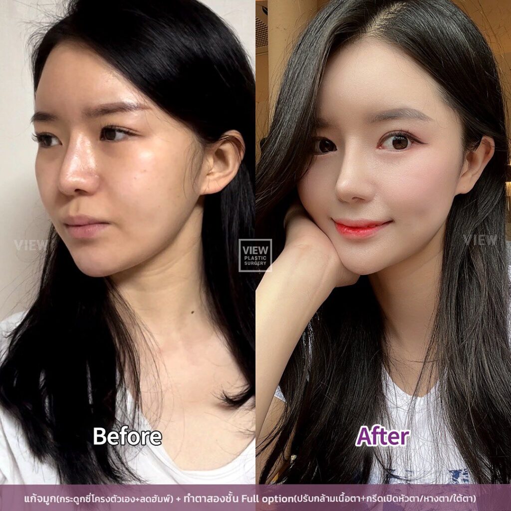 เคส Before & After จาก View