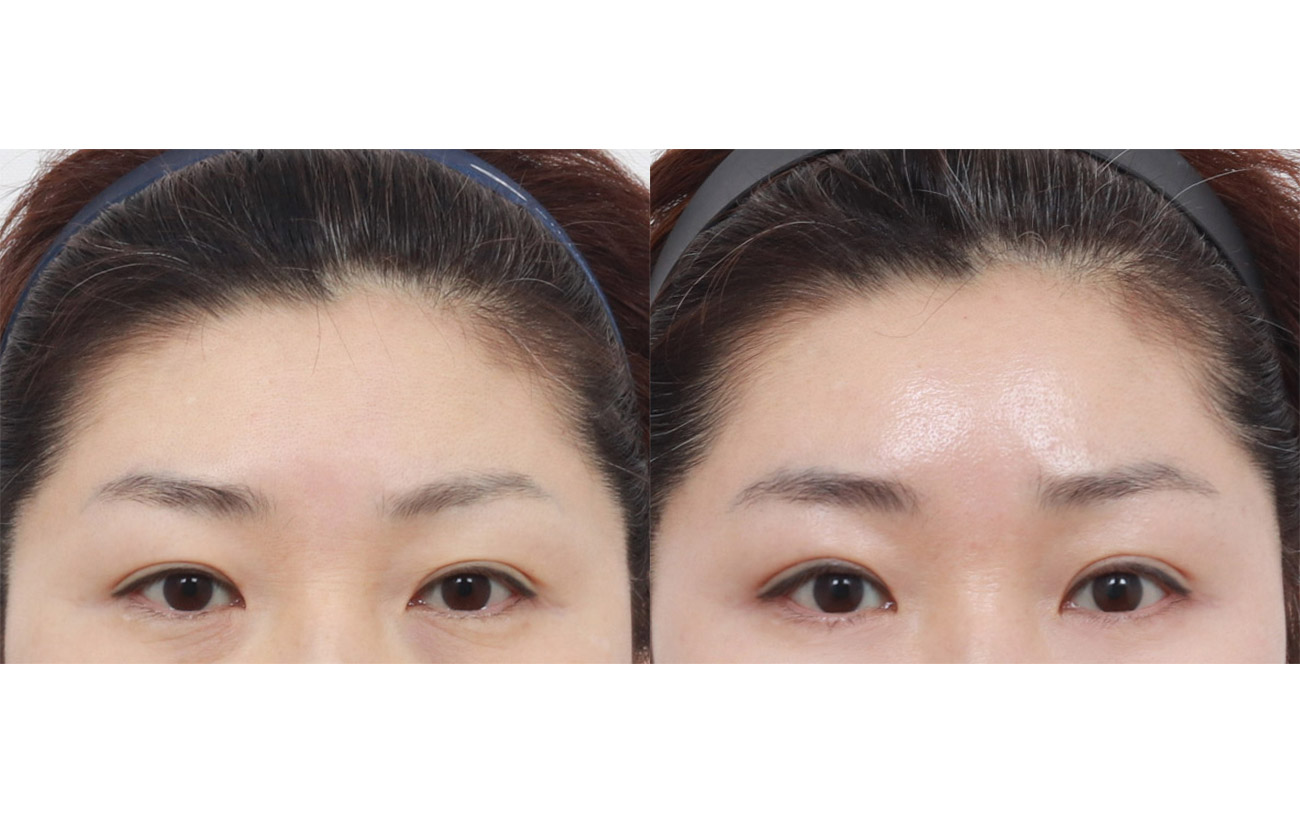 Made Young forehead lift Before and After 1 month