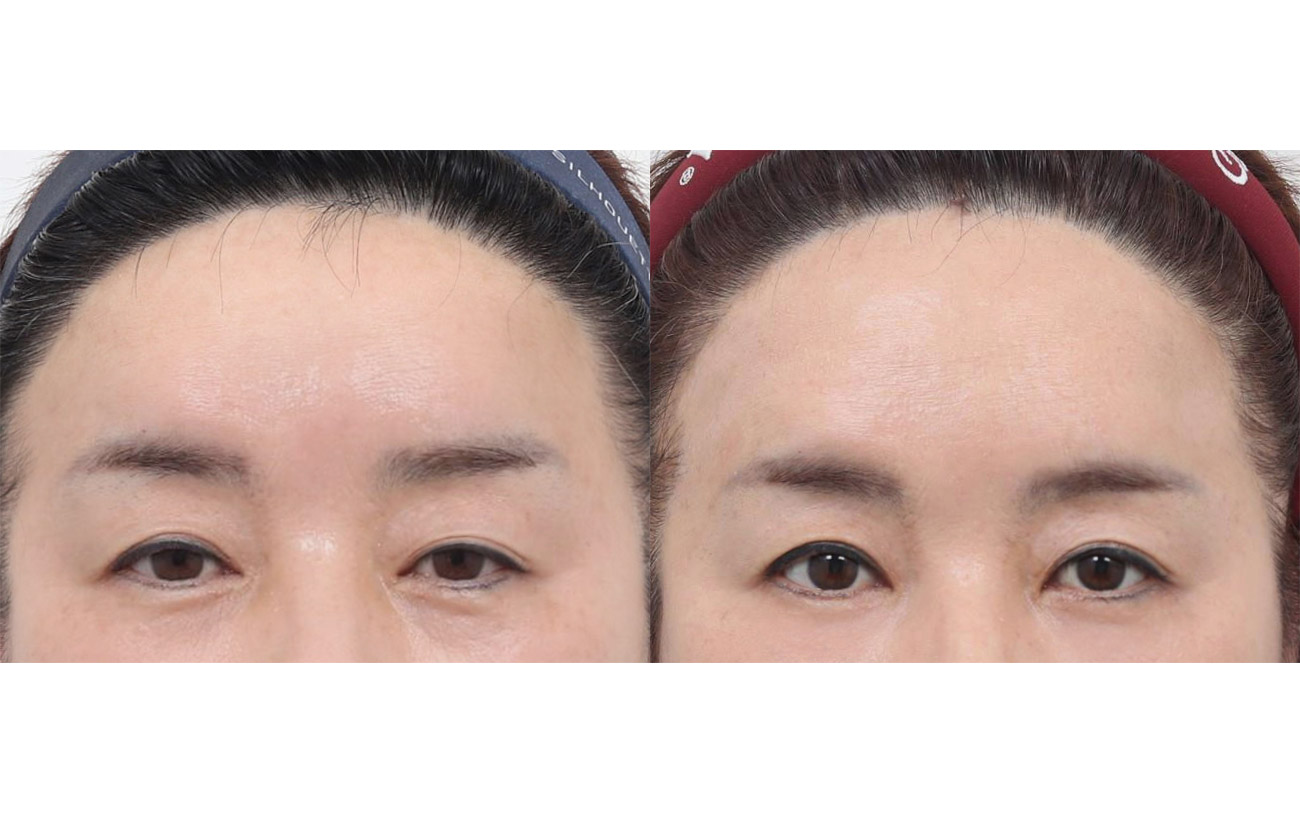 Made Young forehead lift Before and After 6 months