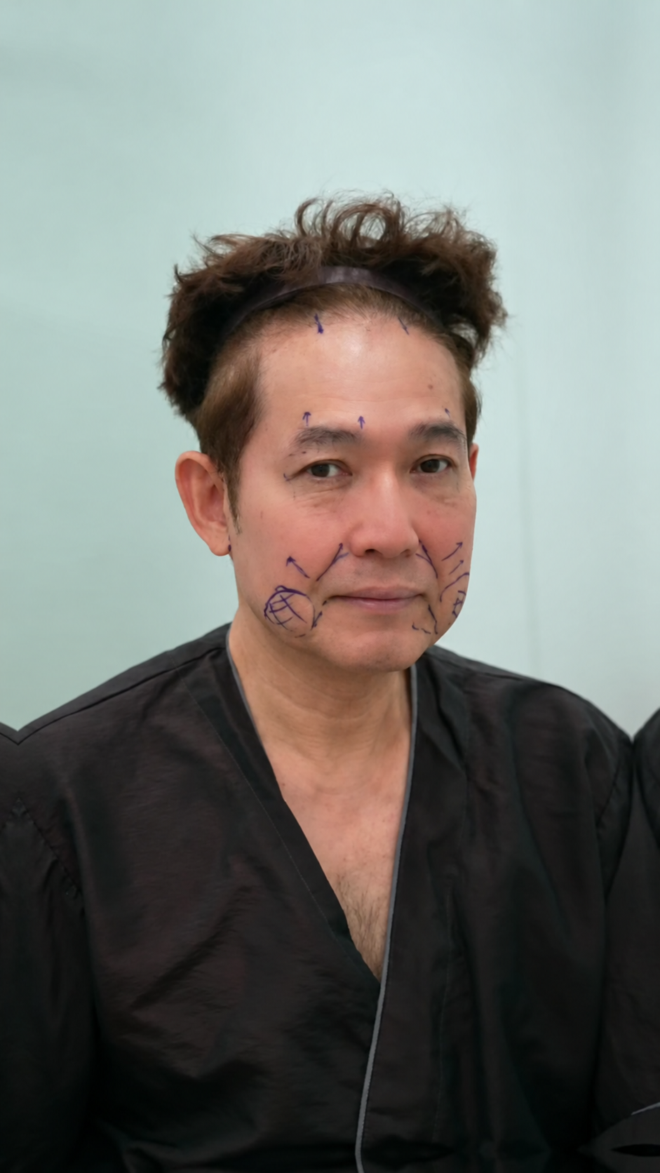 Preoperative planning and markings in the hospital.