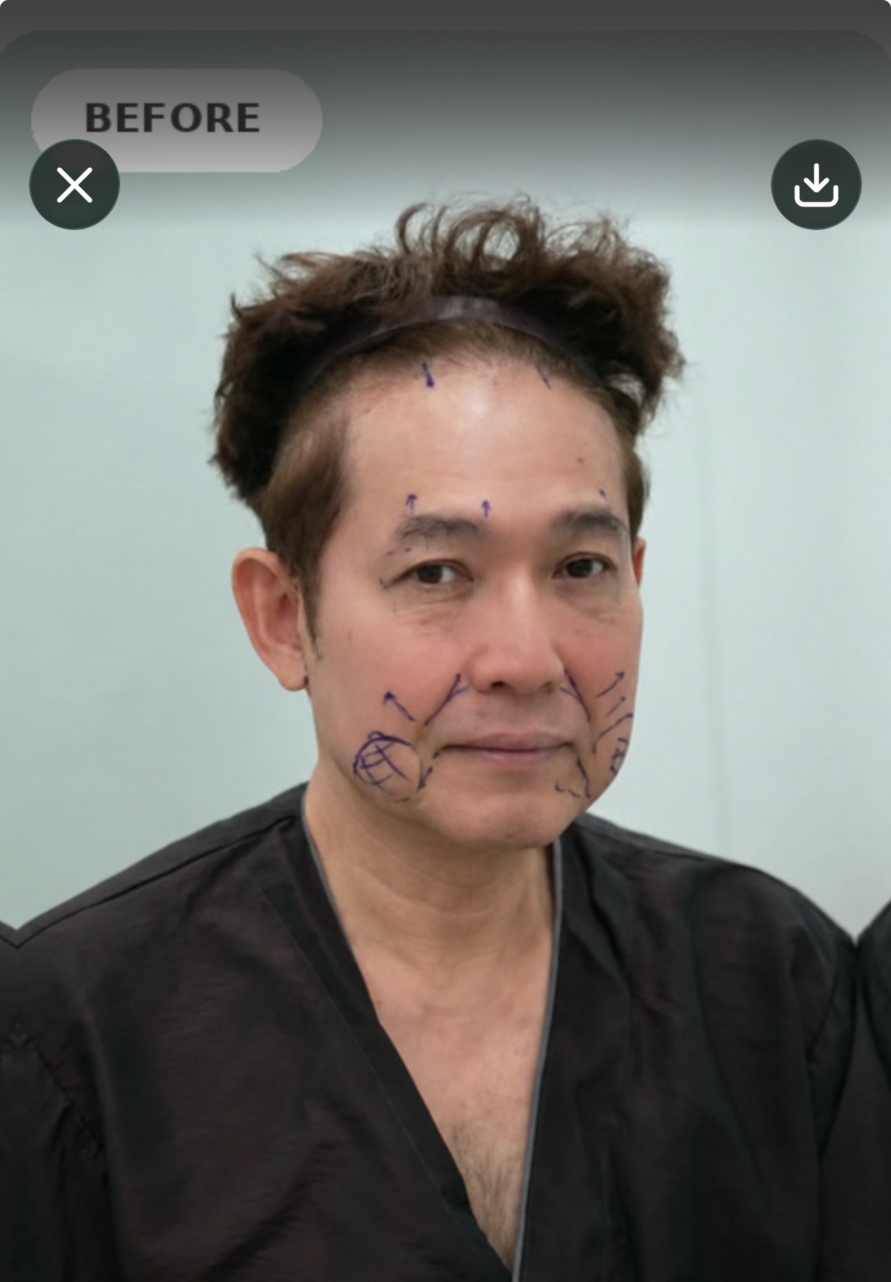 คุณพ่อคุณมะตูมช่วงพักฟื้นหลังผ่าตัดยกกระชับใบหน้าและคอที่เกาหลี รูปที่ 1